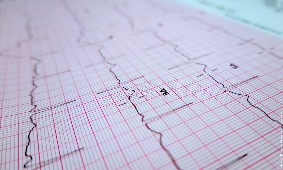 Auf was Sie beim EKG Gerät kaufen unbedingt achten sollten